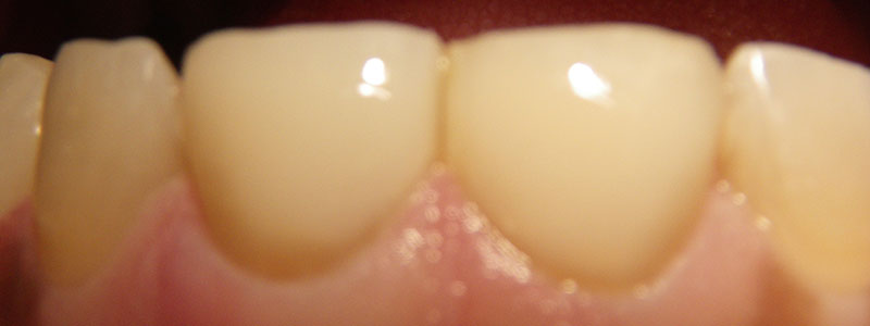 Before and After Patient Photo - Dr. Stephen J. Krawiec, DDS, PC