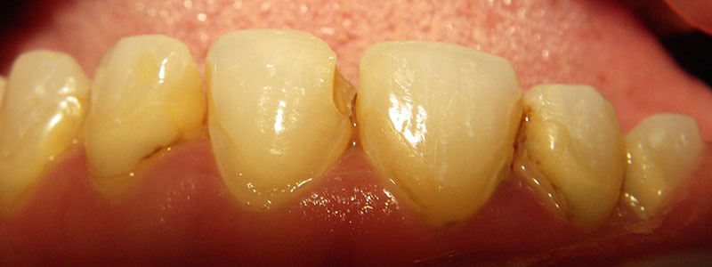 Before and After Patient Photo - Dr. Stephen J. Krawiec, DDS, PC